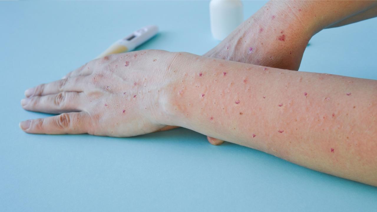 M-Çiçeği (MPox) Rehberi Güncellendi